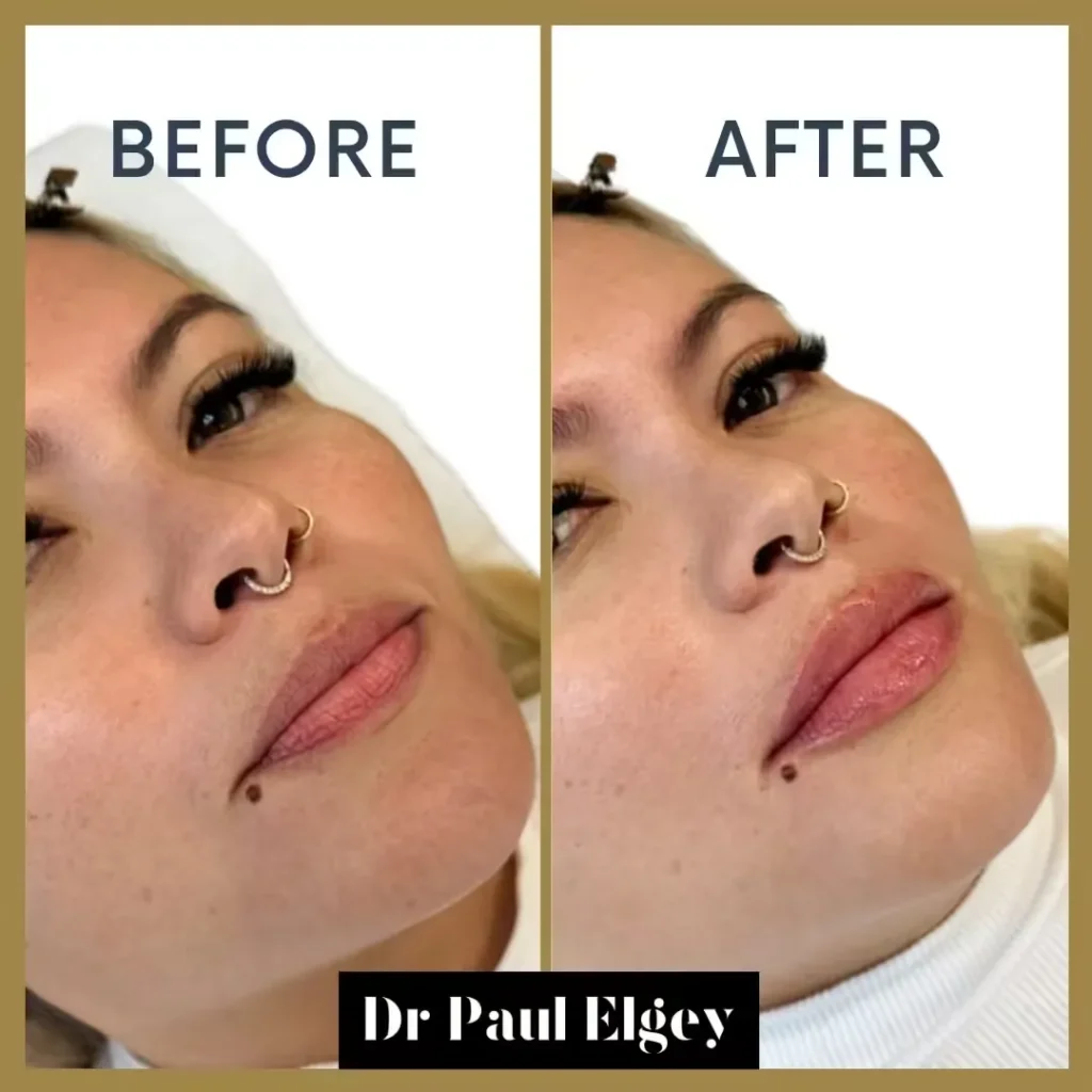 imgi_17_Lipbeforeandafter-jpg